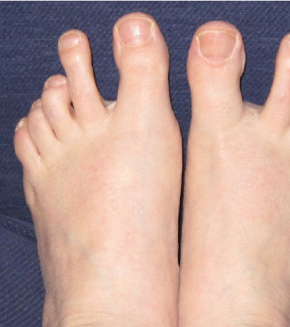 Are You Brave Enough To Check Out The Ugliest Feet In The World?