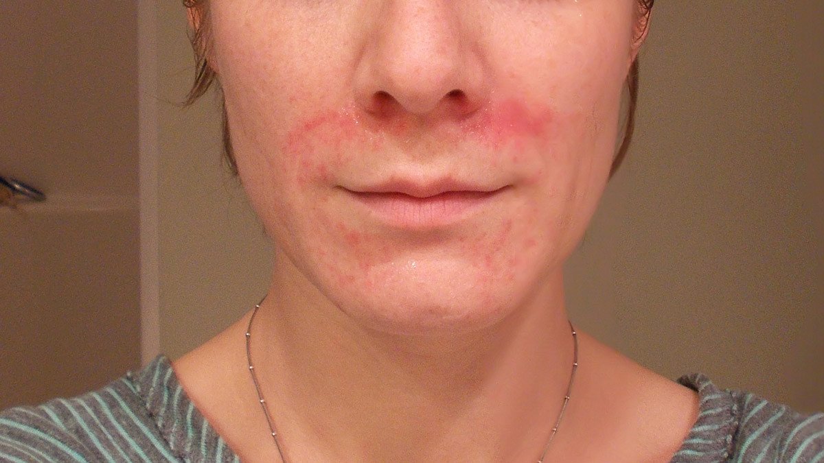 Facial Eczema Symptoms Treatments And Causes 3415