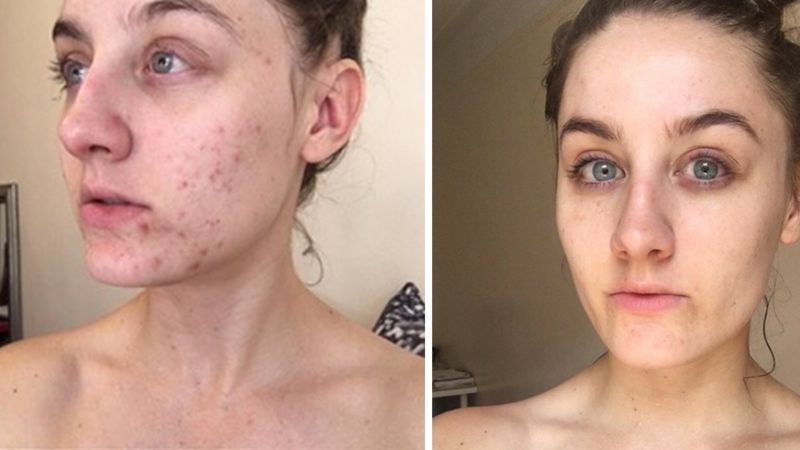 This Woman Stopped Washing Her Face For Six Months And Cured Her Acne