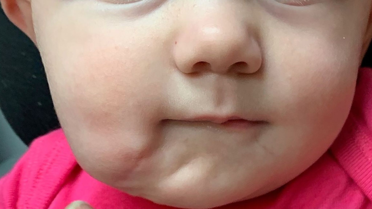 6 month old baby goes under the knife to remove her second mouth