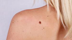 Skin Cancer Abcde The Simple And Effective Method For Identifying A High Risk Mole